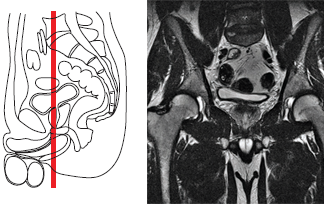 მცირე მენჯის ღრუს ორგანოების მაგნიტურ-რეზონანსული ტომოგრაფია კაცებში (სურათზე ჩანს წინამდებარე ჯირკვალი (პროსტატა), სათესლე პარკები, შარდის ბუშტი და შარდსაწვეთი).